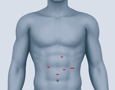 Bild minimalinvasiver Eingriff