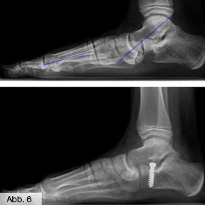 Bild Orthopädie Fuß Calcaneusstopschraube