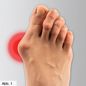 Bild Orthopädie Fuss Hallux Valgus