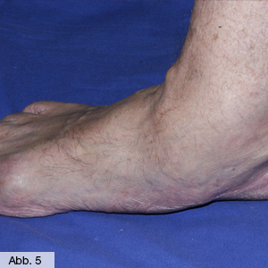 Bild Orthopädie Fuß Knicksenkfuss