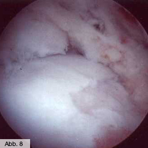 Bild Orthopädie Fuss Knorpelsprunggelenk