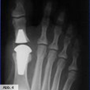 Bild Orthopädie Fuss Zehprothese