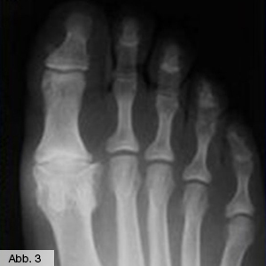 Bild Orthopädie Fuss Zeh