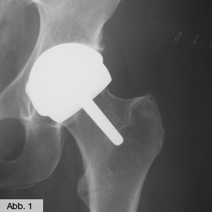Bild Orthopädie Hüfte Oberflächenersatz