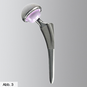 Orthopädie Hüfte Standardschaft