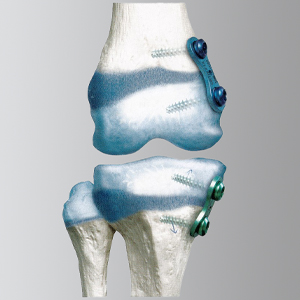 Bild Orthopädie Kinderachskorrektur