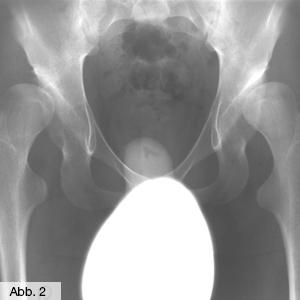 Bild Orthopädie Kindhüftdysplasie