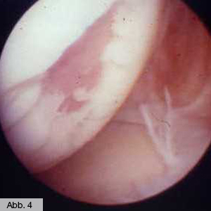 Bild Orthopädie Knieknorpelschaden