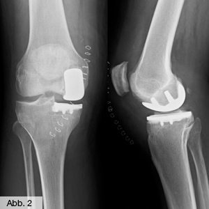 Bild Orthopädie Knie Schlittenprothese