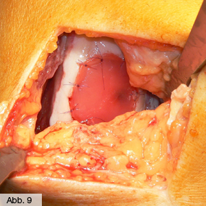 Bild Orthopädie Knorpelacttransplantat