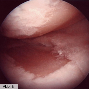 Bild Orthopädie Knorpelglatze