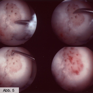 Bild Orthopädie Knorpelmicrofracturing