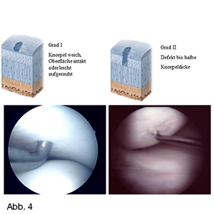 Bild Orthopädie Knorpelschaden 1-2