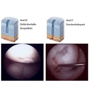 Bild Orthopädie Knorpelschaden 3-4