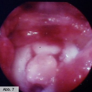 Bild Orthopädie Knorpel Transplantat eingesetzt
