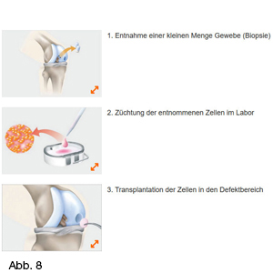 Bild Orthopädie Knorpeltransplantation