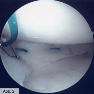 Bild Orthopädie Meniskusnaht