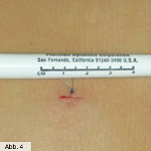 Bild Orthopädie Naht Bandscheibe