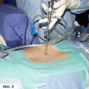 Bild Orthopädie OP Bandscheibe