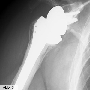 Bild Orthopädie Schulterinversprothese