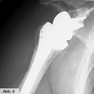 Bild Orthopädie Schulter Inverse Prothese