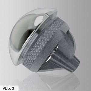 Bild Orthopädie Schulter Kurzschaftprothese