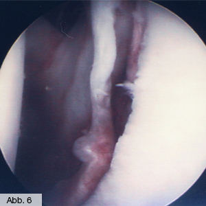 Bild Orthopädie Schulterlabrumschaden