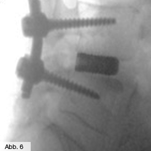 Bild Orthopädie Spondylodese OP