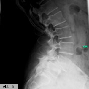 Bild Orthopädie Spondylodese