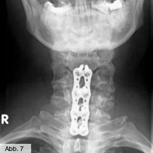 Bild Orthopädie Wirbelgleiten
