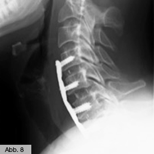 Bild Orthopädie Wirbelgleiten