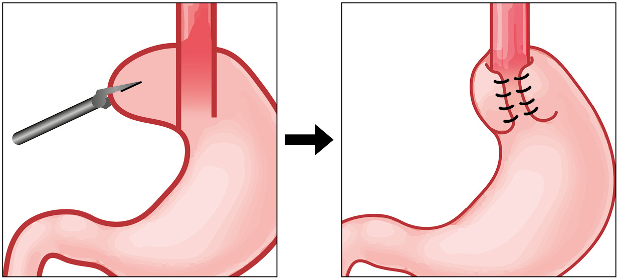 Bild Hemifundoplikatio Illustration