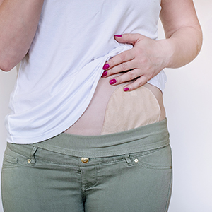 Bild Patientin mit Stoma